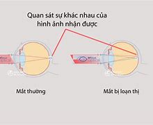 Cận Thị Là Gì Khtn 8